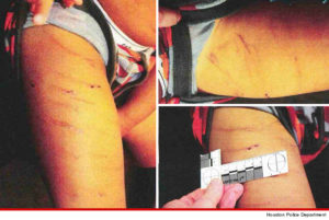 Images of Adrian Peterson's son after a "whooping' the NFL star allegedly administered.