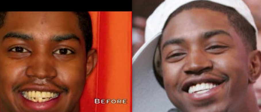 nicki minaj teeth before and after