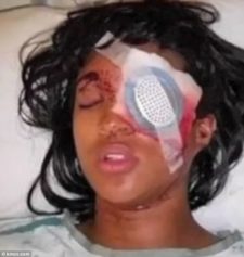 Pregnant Woman In Ferguson Loses Eye After Being Fired On By Police With 'Bean Bag'