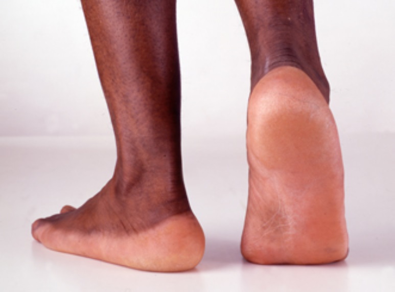 callus rough feet Atlanta Black Star