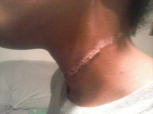 Sandy Rougely says her daughter returned home from a camping trip with this rope burn covering the front half of her neck. Photo courtesy of Sandy Rougely