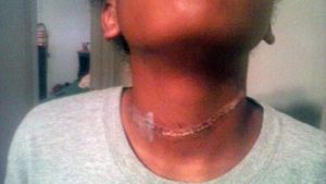 A photo showing the severe rope burns a 12-year-old girl sustained while on a school camping trip. Photo provided by Sandy Roguely's attorney, Levi G. McCathern II.