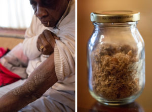 Rollins Edwards, who lives in Summerville, S.C., shows one of his many scars from exposure to mustard gas in World War II military experiments. More than 70 years after the exposure, his skin still falls off in flakes. For years, he carried around a jar full of the flakes to try to convince people of what happened to him. Source: AMELIA PHILLIPS HALE FOR NPR