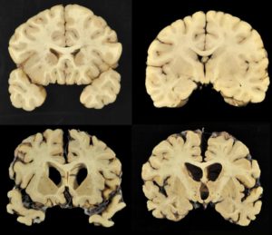 Boston University shows sections from a normal brain, 