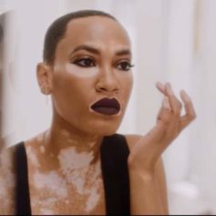 Vitiligo Cover Girl Amy Deanna Shares Why She Chose Not to Change Her Skin Color