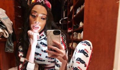 Winnie Harlow Gave an Epic Response to Someone who Mocked Her Vitiligo Condition