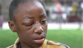 11-Year-Old Beaten So Bad By Two Adult Women She Has to Get Two Eye Surgeries; No Arrests Made