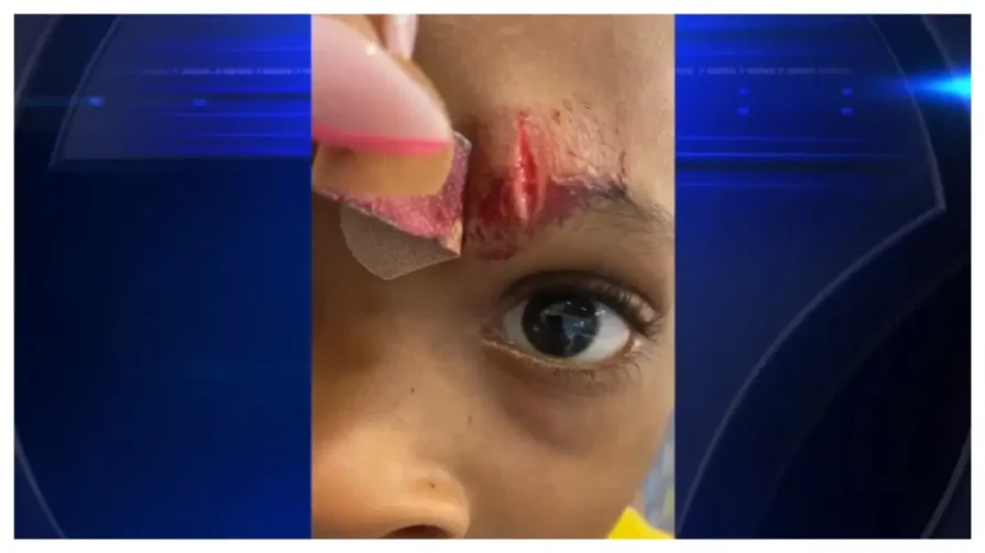 Florida child left with gash on forehear