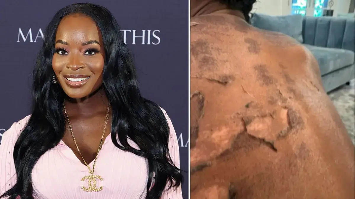 ‘Chileee Somebody Lying’: Atlanta Doctor Blasts Shamea Morton’s Lawusit Over Damaging Chemical Peel — and Doc’s Version Tells a Different Story